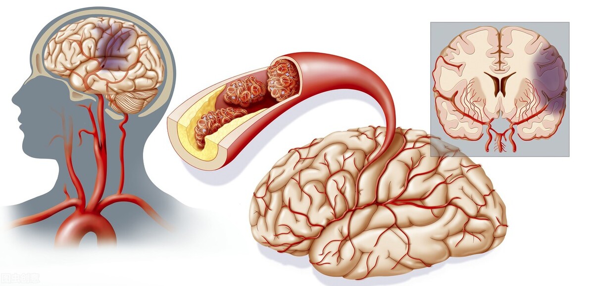 中国脑梗发病率世界第一，原因主要是这几个！5个建议远离脑梗