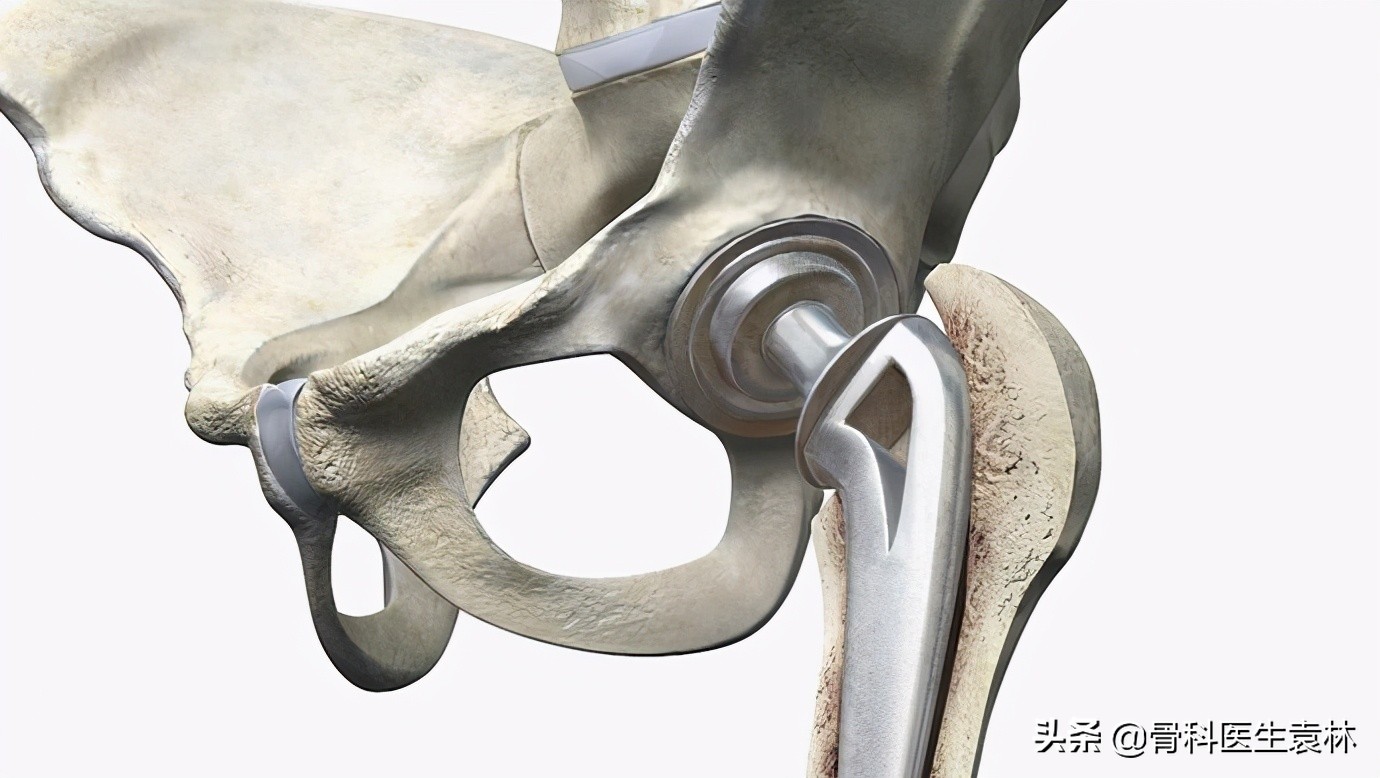 髋关节置换人工假体种类那么多,到底应该怎么选?