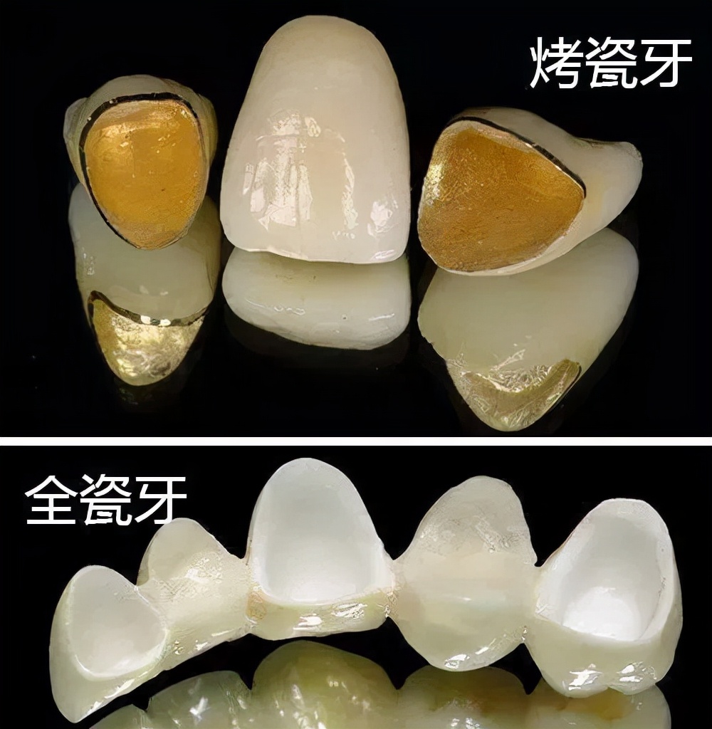 Is there any difference between porcelain teeth and all porcelain teeth