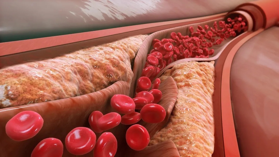 关注血脂的看过来！血脂与胆固醇有什么关系？