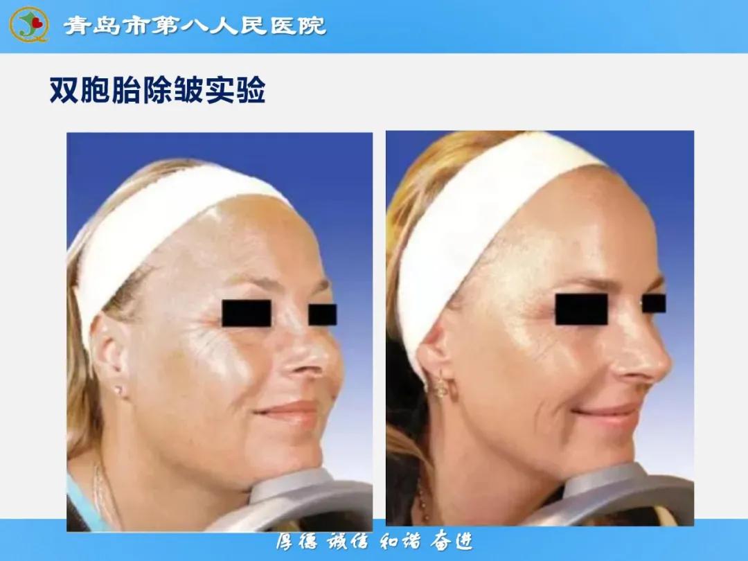 健康科普大赛获奖作品展示⑭丨肉毒毒素微整注射