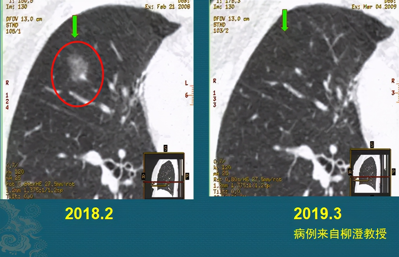 磨玻璃肺结节随访观察，会不会变成肺癌？医生带你看随访4种结局