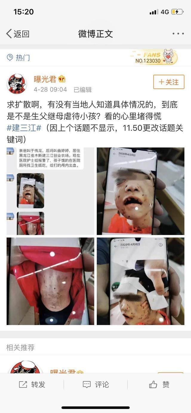 令人发指！这个恶魔后妈，剪开了4岁女孩的嘴唇