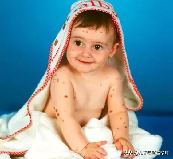 身上长有500多块胎记的女孩，曾被当怪物看待，