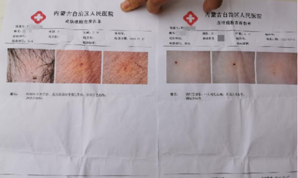 红黄蓝事件重演？呼和浩特一幼儿园多名孩子身上出现不明针眼