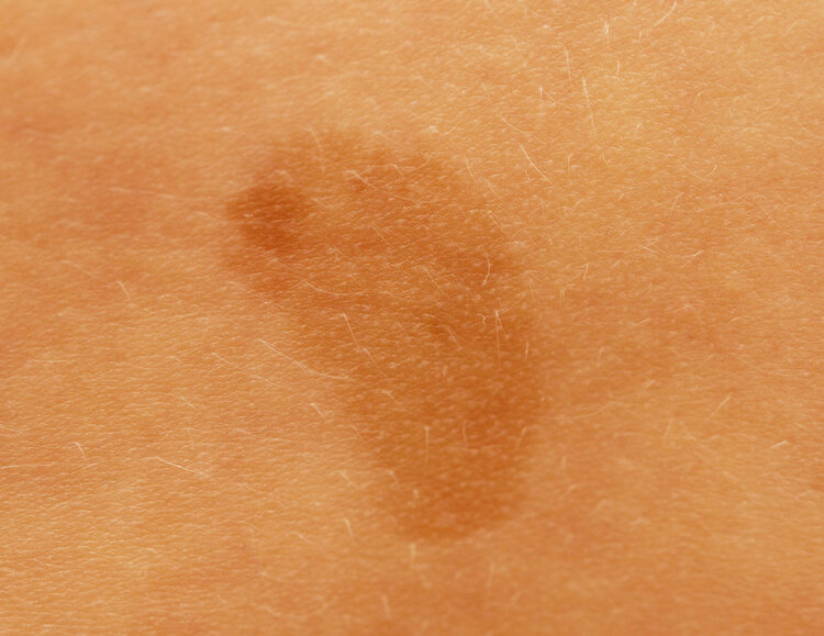 Why do many newborn babies have a "bruise" on their buttocks? Finally