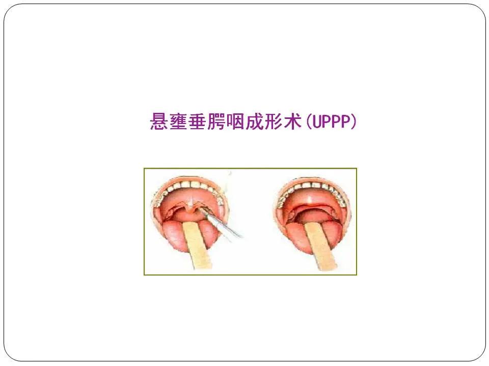 “睡眠呼吸暂停与心血管风险”健康大课堂