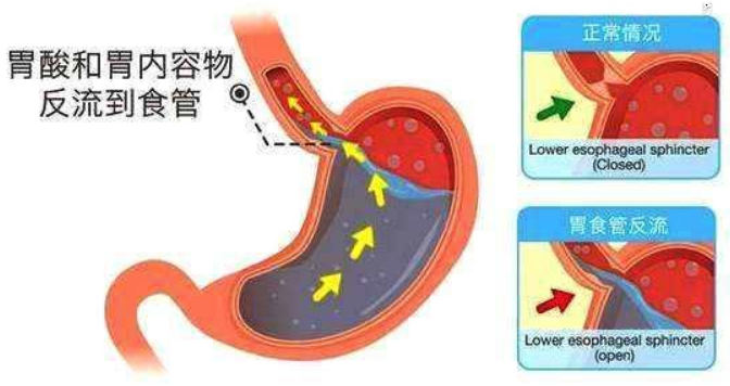 你还在“烧心”吗？常见原因有哪些，怎么治？看完秒懂