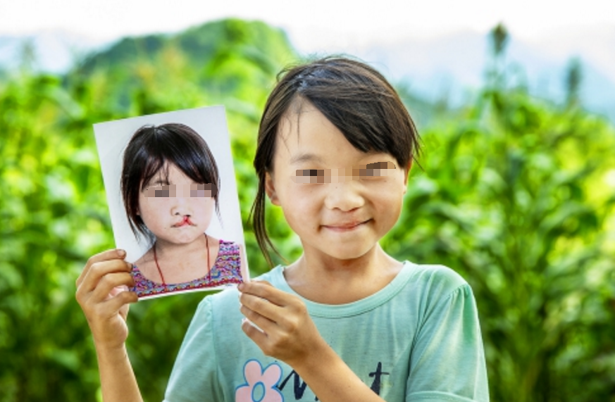 14歲李嫣曬照為爸爸慶生，經(jīng)歷3次手術(shù)擺脫“兔唇”，美到不敢認(rèn)