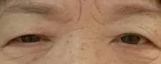 科普——眼整形手术是个什么手术?(多图)
