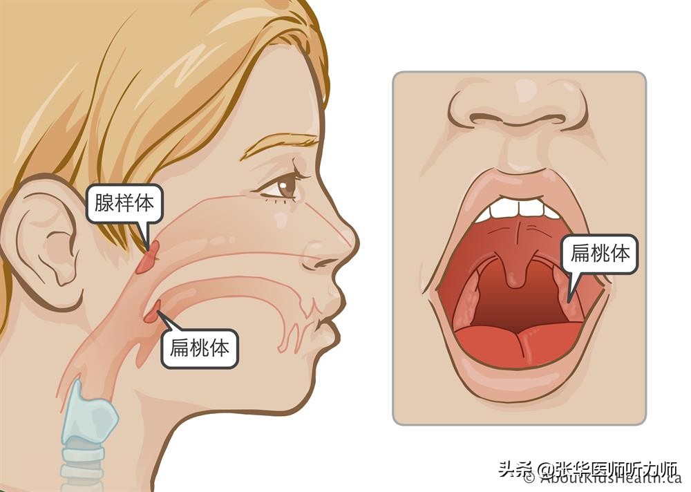 切除兒童的扁桃體和腺樣體會增加患28種疾病的風險