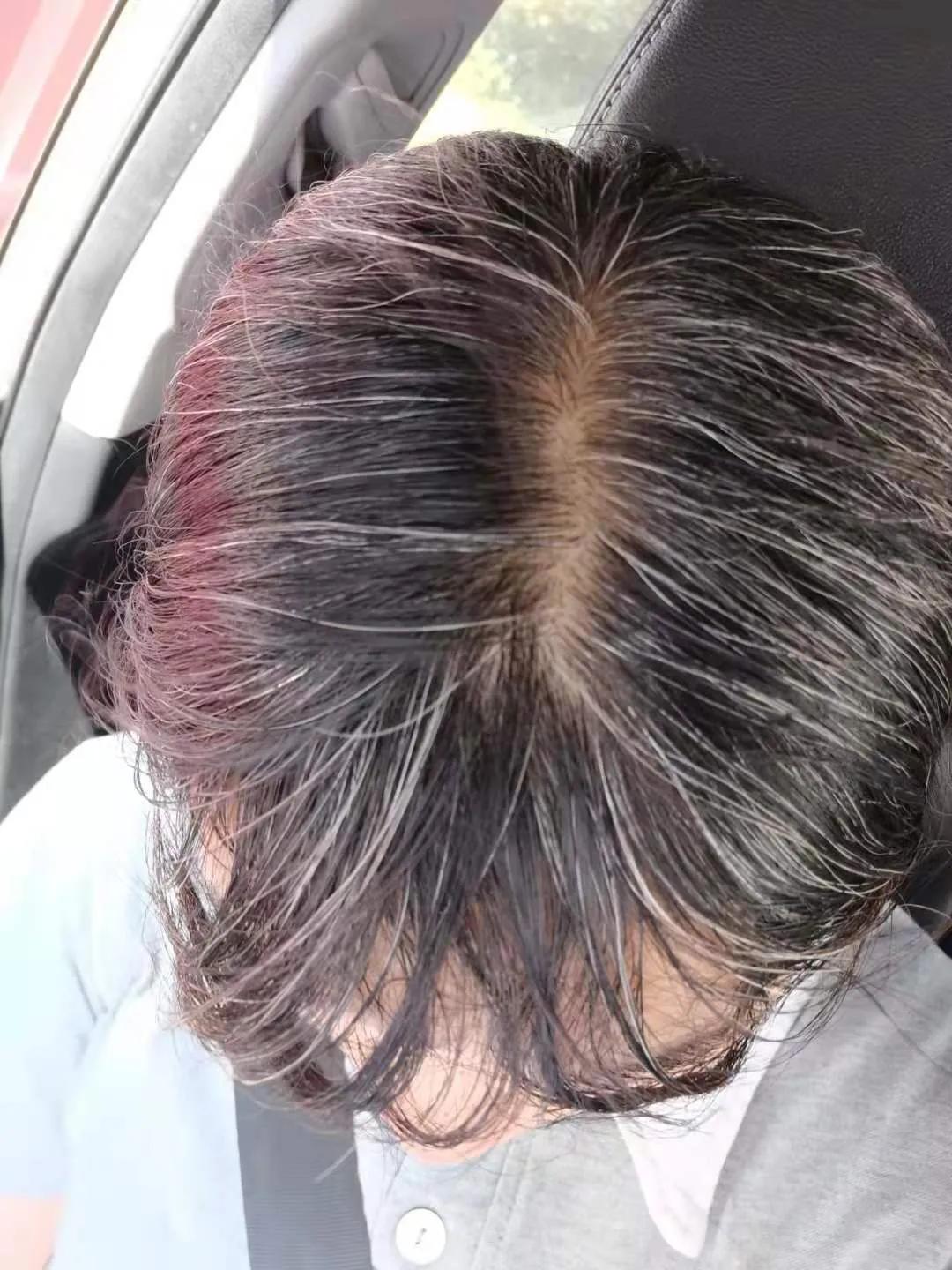 How does gray hair turn black?Share my personal experience iNEWS