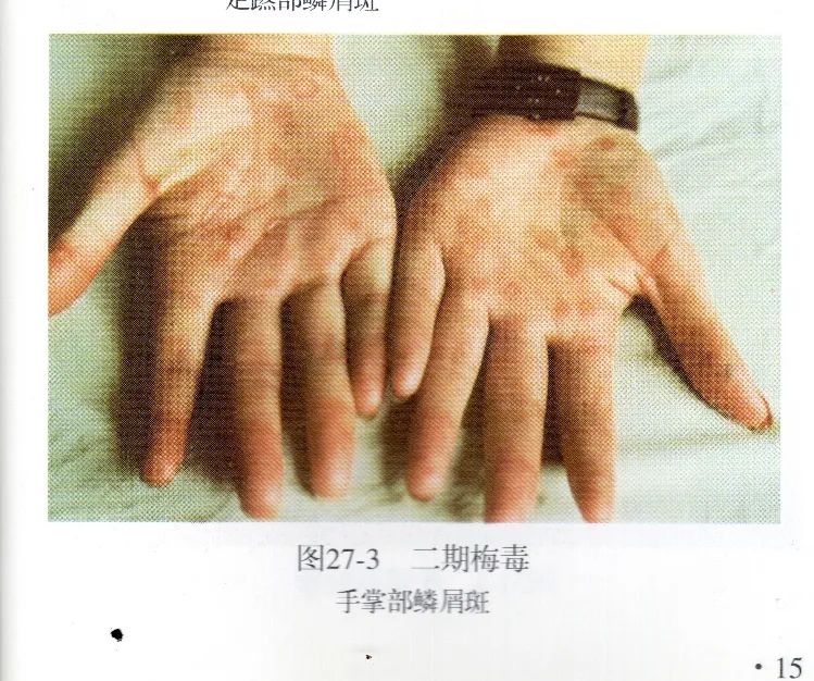 梅毒患者的悲劇令人痛心，美國總統(tǒng)致歉，殘忍的人體實驗需要底線