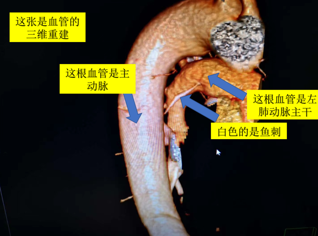 一个月拔500根鱼刺！富阳阿姨开胸取刺才保住命，都怪一碗酸菜鱼！