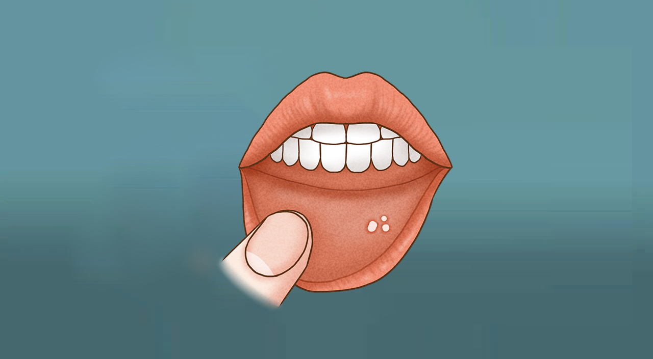 经常出现口腔溃疡，维生素要不要补呢？