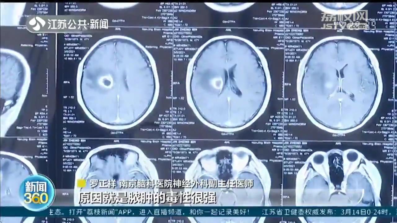男子挤痘痘，引发颅内脓肿导致瘫痪，&ldquo;危险三角区&rdquo;别乱碰