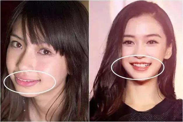 明星整牙前后的对比，堪比整容，看完你就知道牙齿有多么重要