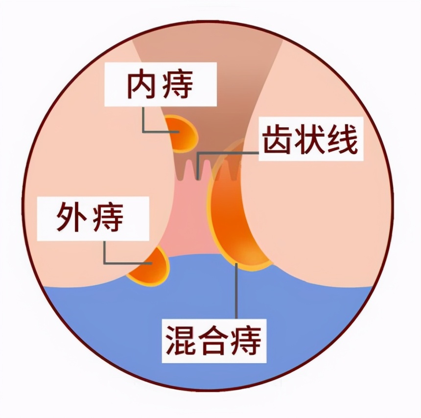 菊情战略局新闻发布会之应对痔疮疫情