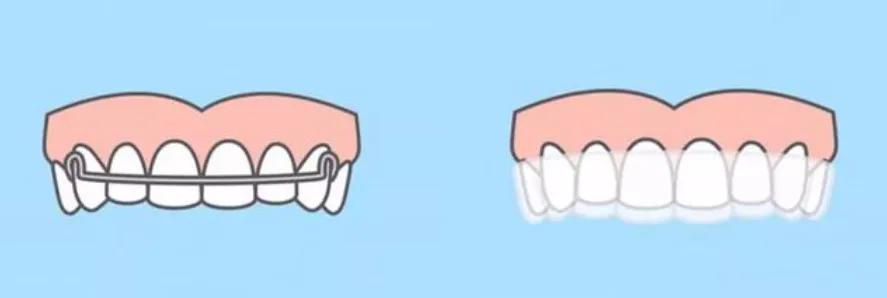 牙齿矫正一半靠医生一半靠自己