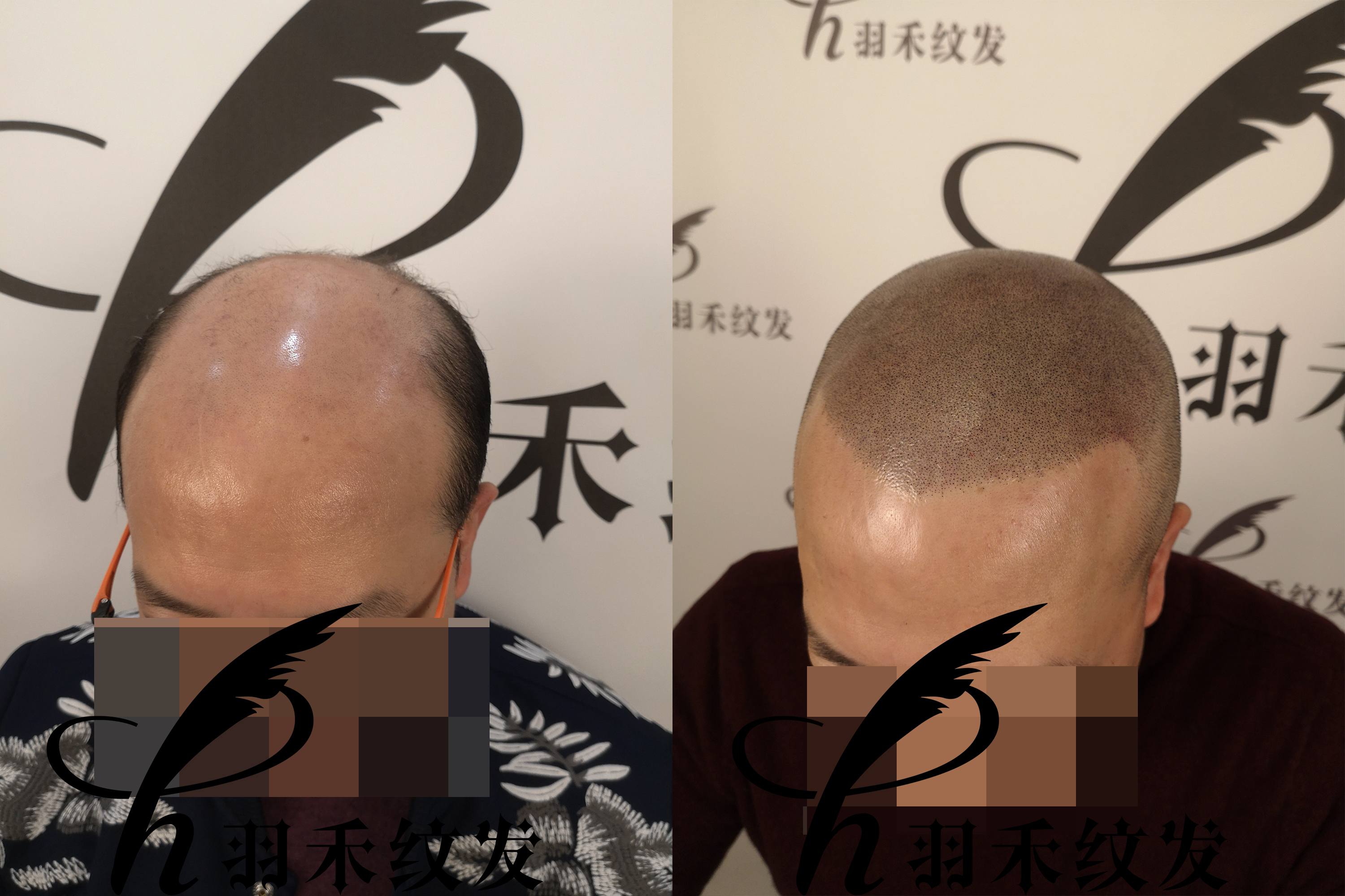 纹发后还能戴假发吗？