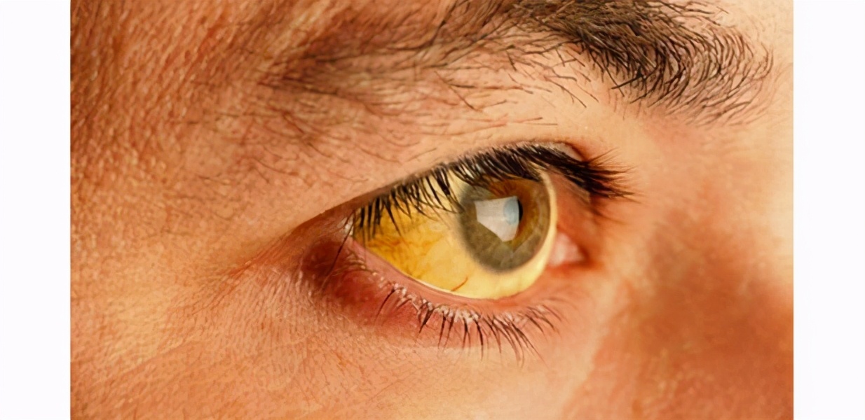 如何得知患有肝病？ 這些徵兆請注意，肝病分4階段，怎麼防治？