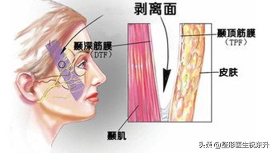 面部轮廓开始（已经）走样，可以考虑拉皮手术，纠正"垂、松、垮"