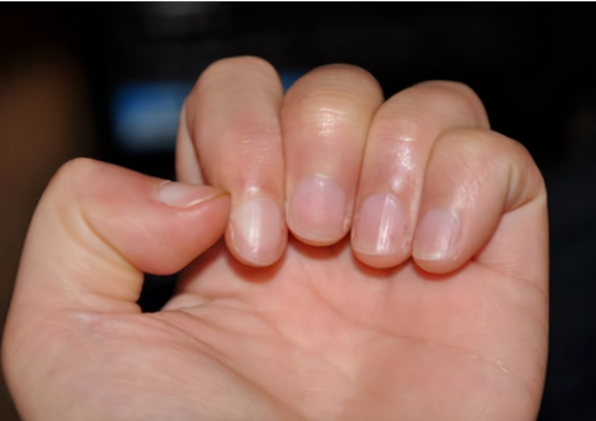 The nails are covered with vertical lines, is there a problem with the