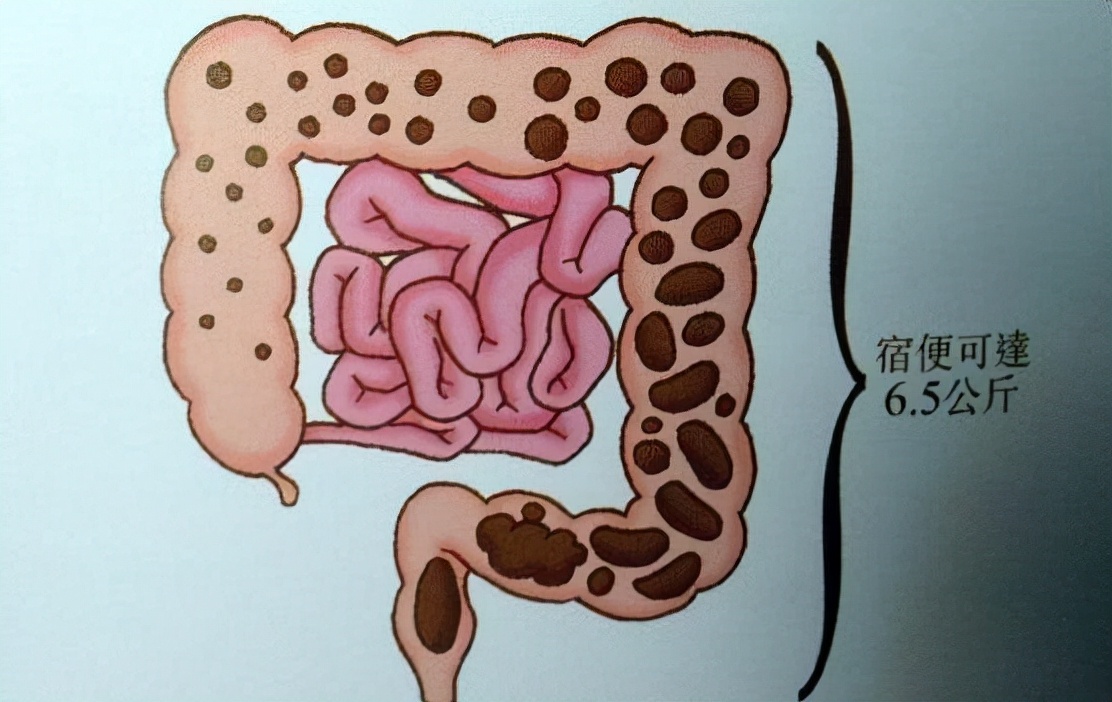Is there really 6 kg of stool in the human body?How to deal with those