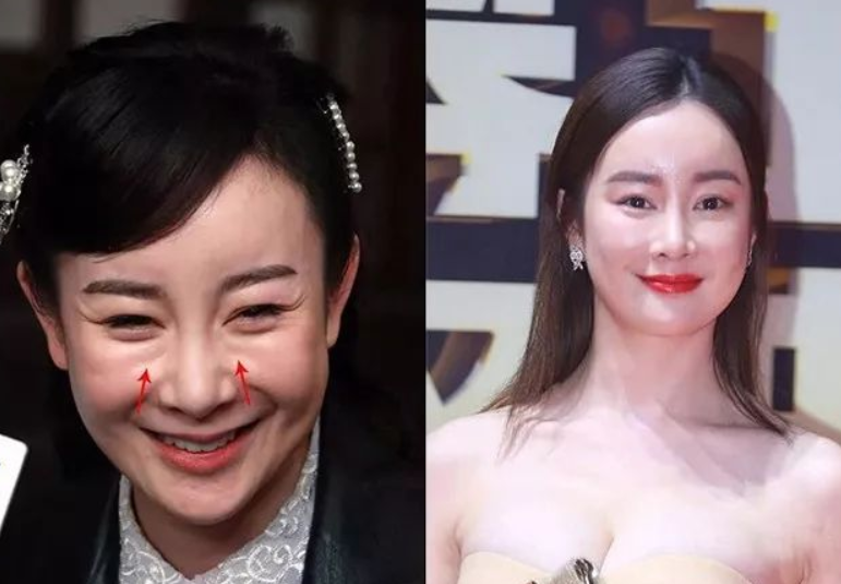 有人整容成功变仙女，也有人整容失败变惊悚，网友：云泥之别