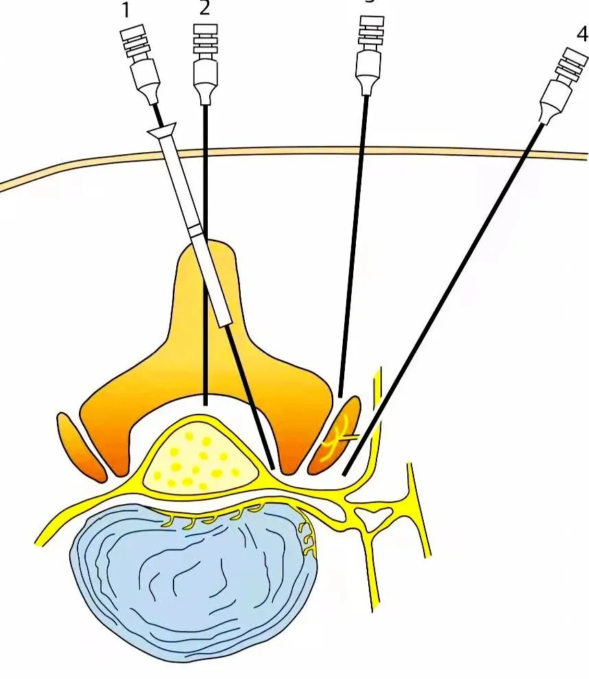 脊柱科普|选择性神经根阻滞"一箭双雕"→诊断 治疗