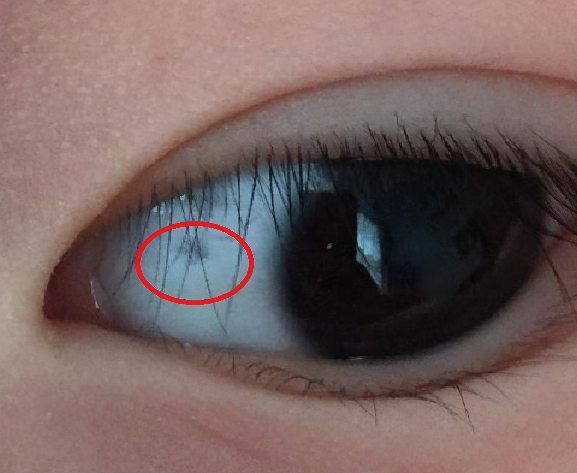 why-do-children-have-black-spots-in-their-white-eyes-mostly-caused