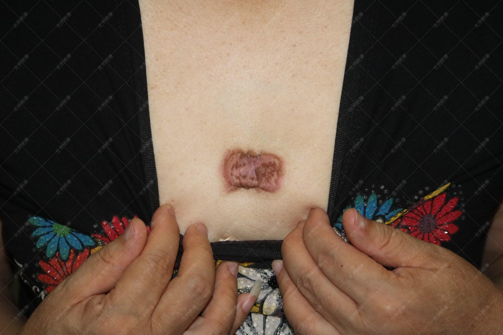 Ruby Scar (Scar Kang) A ruby scar on his chest - iNEWS