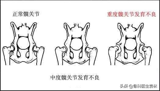 髋关节发育不良对身体有什么影响