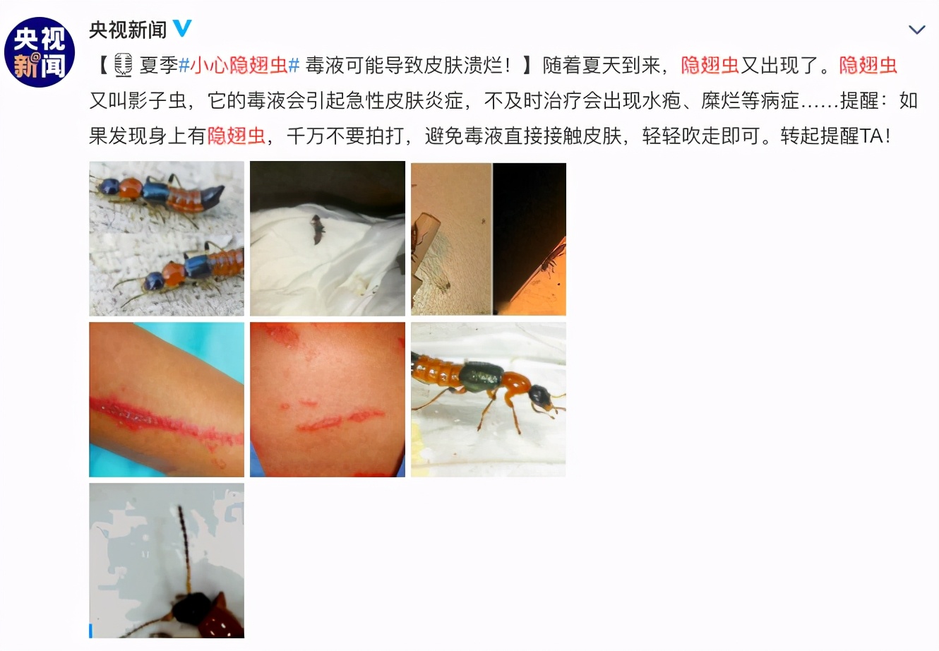 隐翅虫飞到孩子脸上宝妈用这3步处理法从容救娃医生干得好