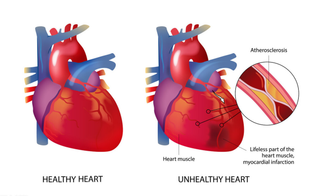 為什麼會導致心肌缺血？ 醫生：養成3個習慣，心臟或許更有力