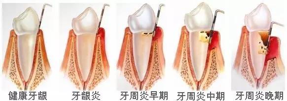 不能洗牙的日子…我听说红糖水能去除牙垢？