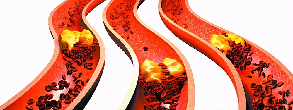 血管真的需要及時排毒清垃圾？ 別被忽悠了！ 這四個認識誤區請收好