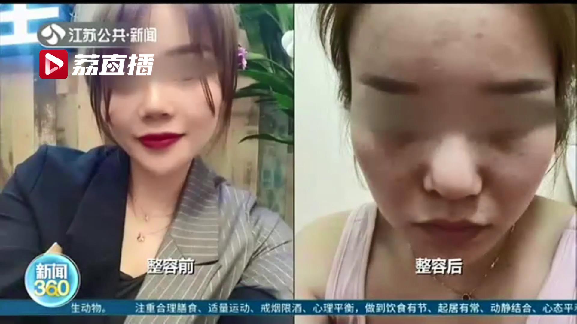 女子整形后鼻子歪了！院方称可修复，他们私自存了肋骨