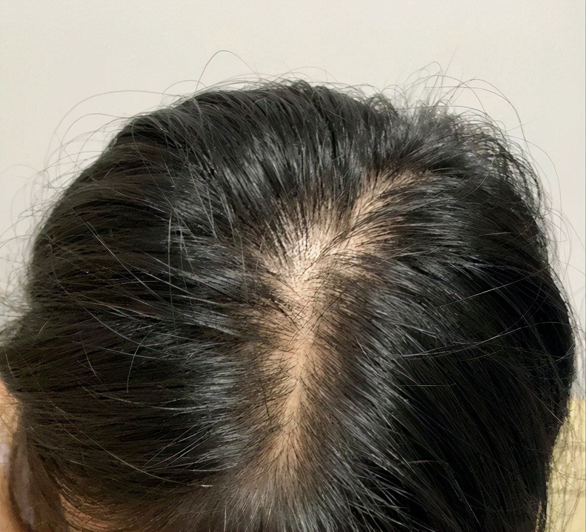 Is hair gap width considered hair loss?Can it be restored? - iMedia