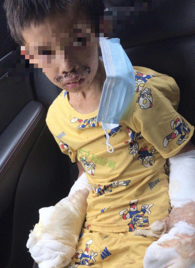 广东7岁男童被父亲用烟头烫、打火机烧，或面临截肢，其父已被刑拘