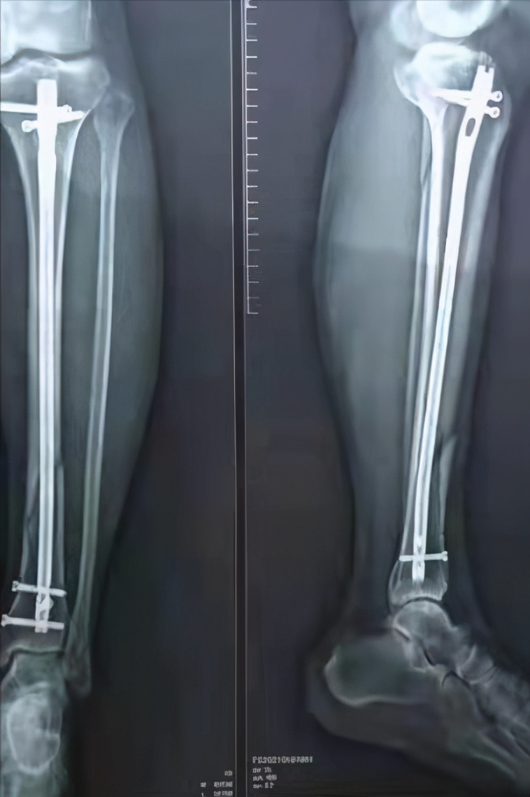 小腿 胫骨 骨折 髓内固定 术后 在家里如何修养 Mp头条