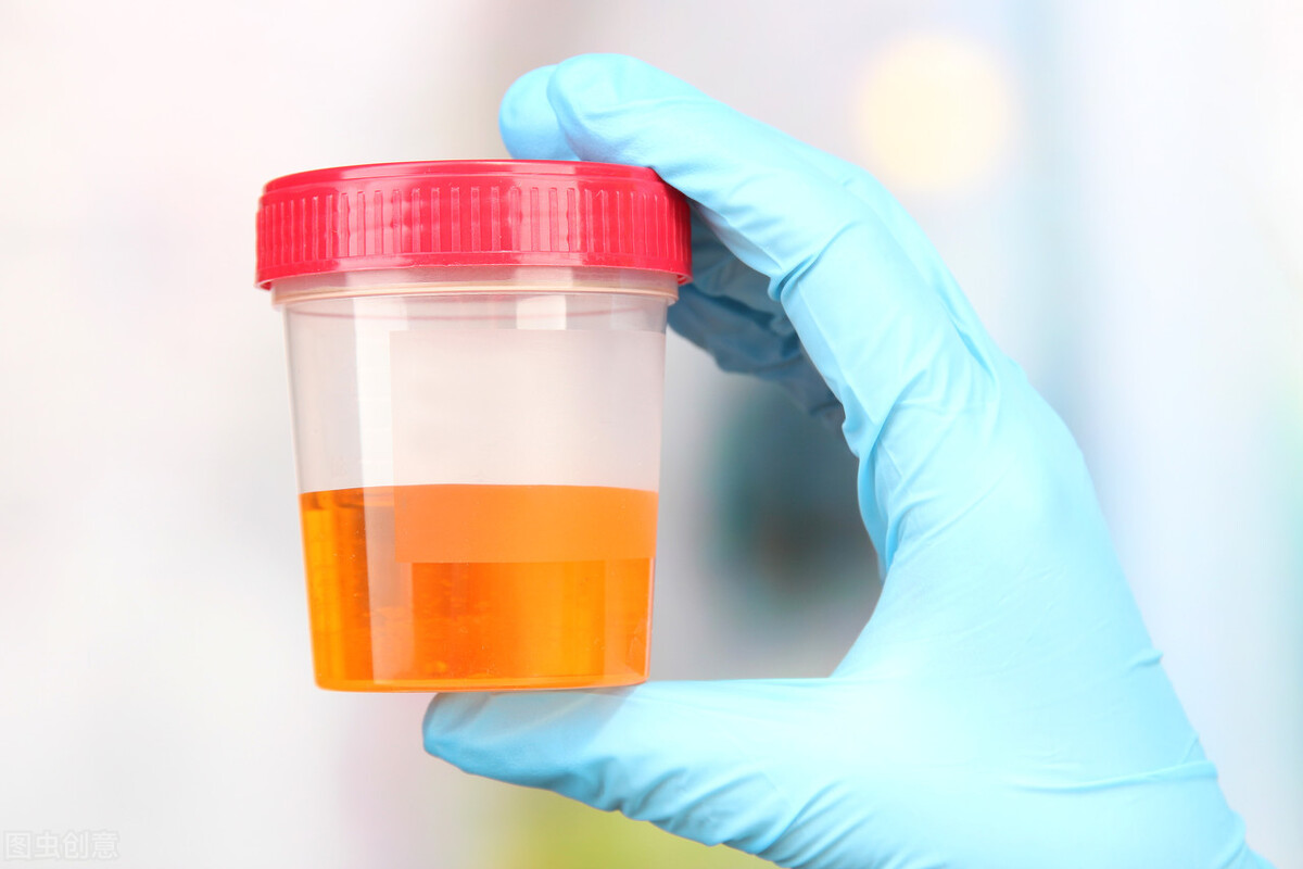 What color is your urine? The urine color represents a kidney disease ...