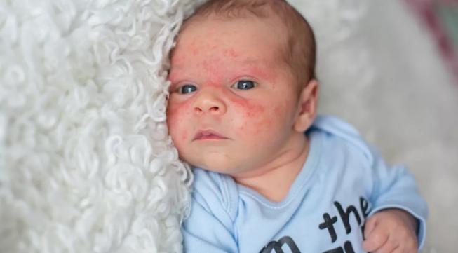 宝宝皮肤干燥 发红发痒 有湿疹怎么办 儿科医生教你这样护理 资讯咖 宝宝皮肤干燥 发红发痒 有湿疹怎么办 儿科医生教你这样护理 资讯咖