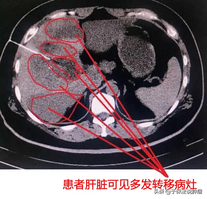 十二指肠肝转移患者经缓释库治疗，病灶消失，取得较满意效果