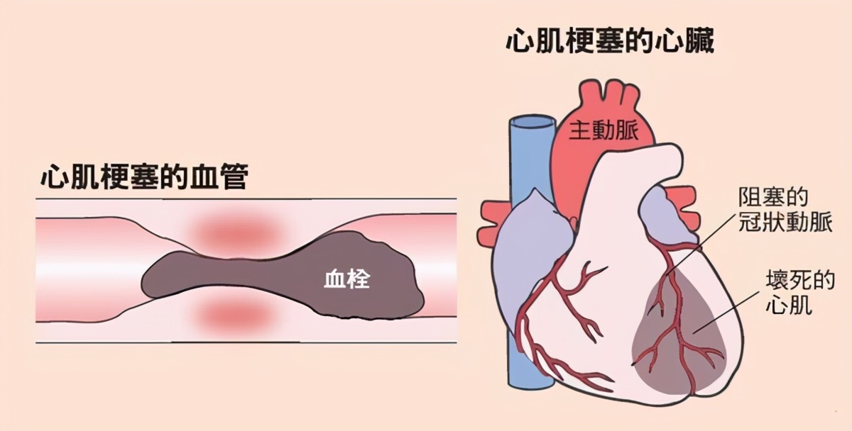 突发心梗如何急救？记住这5点，关键时刻能救命，建议收藏备用