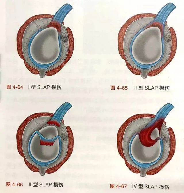 肩关节盂空虚图片