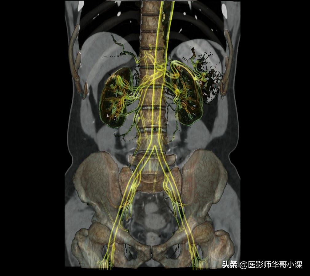 影像ct三维重建图(三维立体融合篇)