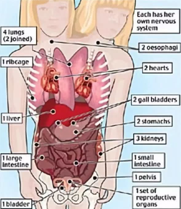 连体人揭秘：其中一个意外去世了，另一个还能