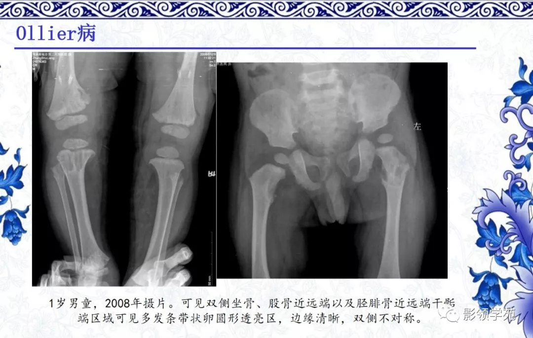 7种常见的软骨源性肿瘤的影像表现