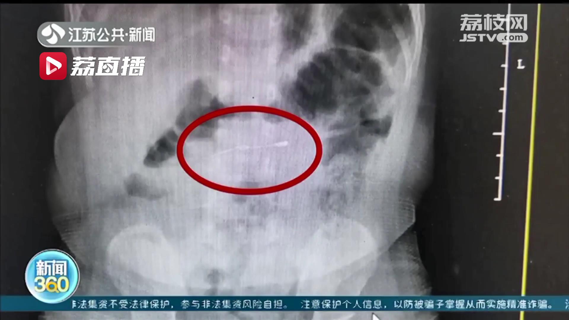 淮安一岁女童误吞别针 医生紧急手术取出
